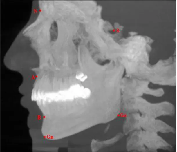 Şekil 3.4. Lateral sefalometrik görüntüde kullanılan iskeletsel noktalar 