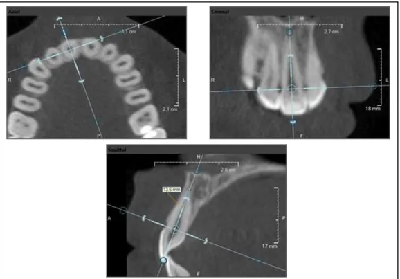 Şekil 3.7. Üst sağ santral dişin kök uzunluğunun ölçülmesi 