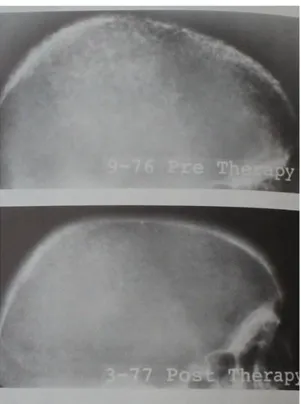 ġekil 4.  Kronik  Böbrek  Hastalığının  son  dönemlerinde  (Evre  IV-V)  görülen  Sekonder  Hiperparatiroidideki  ağır  kemik  değiĢikliklerini  gösteren  bir  baĢka;  tedavi  öncesi  ile 