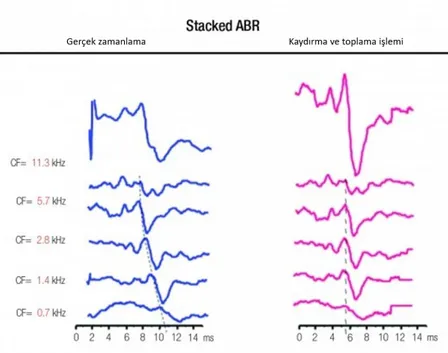 Şekil 2.3. Don ve arkadaşları tarafından gösterimi yapılan Stacked ABR kaydı (23). 