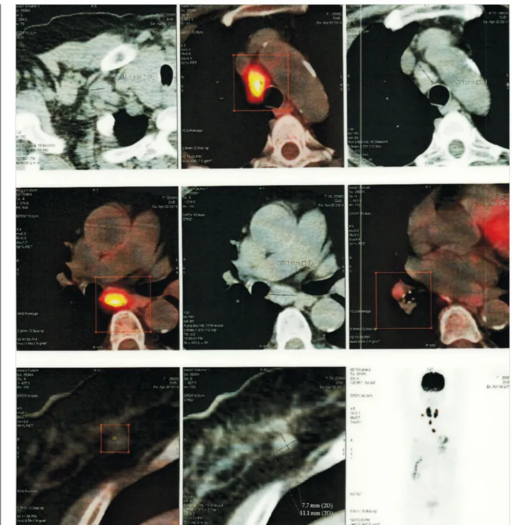 Figure 1. Positron-emission tomography/computed tomography showing intense uptake mediastinal lymphadenopathies  and right breast mass