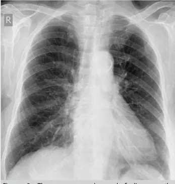 Figure 2. There was no abnormal finding on the  posteroanterior chest X-ray
