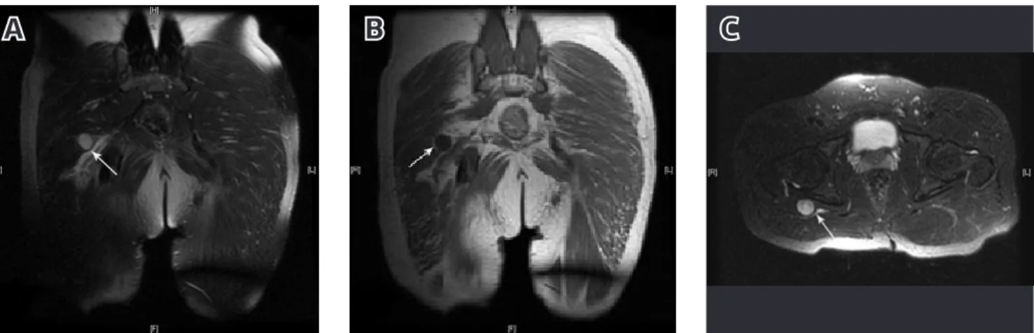 Figure 2. The appearance of the sciatic nerve and schwannoma during surgery (A), The appearance of the sciatic nerve after total excision of the mass (B).