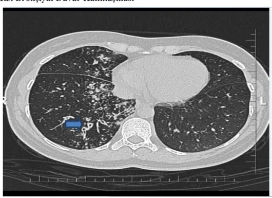 ġekil 14: Ağır sigara içicisi hastada sağ akciğer alt lobda belirgin bazal segmentlerde  bronşiyal duvar kalınlaşmaları izleniyor
