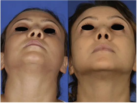 Figure 3 Basal view of the patient, preoperatively (left) and 1 month postoperatively (right).