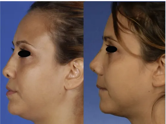 Figure 2 Lateral view of the patient, preoperatively (left) and 1 month postoperatively (right).