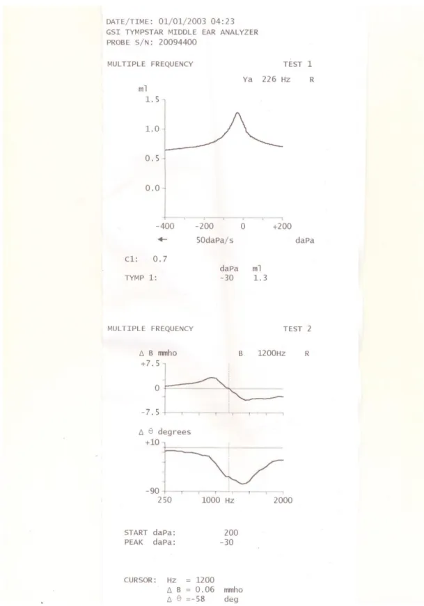 ġekil 10 : Multifrekans Timpanometri Çıktısı 