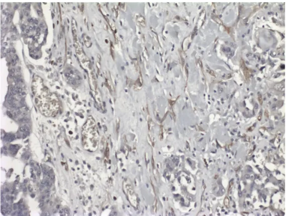 Şekil  4.3:  Epitelyal  over  tümörlerinde  interstisyel  hücrelerin  membranlarında  AQP1 