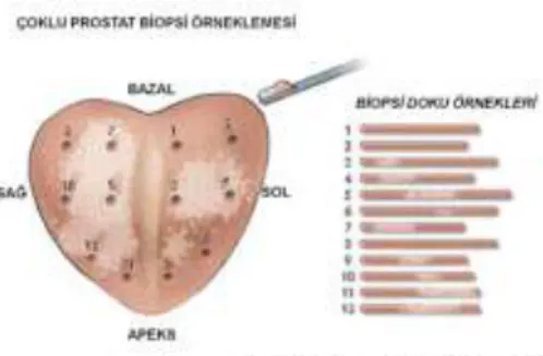 Şekil 6. 12 kor prostat biyopsisi  