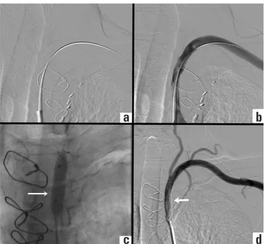Figure 2. Totally occluded segment of the left subclavian artery was  passed with the help of a guide-wire (a), and percutaneous treatment  was performed (b, c)
