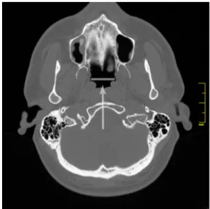 Fig. 1 Craniofacial computed tomography scan. Pharyngeal open- open-ings of the auditory tube were determined on the axial plane
