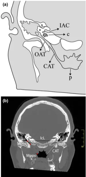 Fig. 3 Reformatted computed tomography image showing inter- inter-cochlear distance (IcD) and anterior nasal spine (ans)