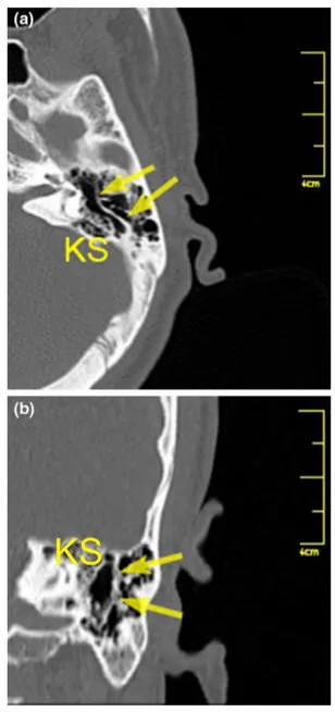 Fig. 6 Reformatted computed tomography images. a Oblique axial image. b Coronal image