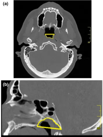 Fig. 8 Reformatted computed tomography images. a Oblique axial image showing nasopharynx axial area (Npax) and the distance between the midpoints of the pharyngeal openings (Mppod)