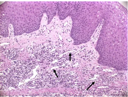 ġekil  4.4  Yüzeyel  epitel  altında    diffüz  Ģekilde    özellikle  vasküler  yapıların  etrafını  saran çok sayıda lenfositten zengin  mononükleer hücre  infiltrasyonu izlenmektedir