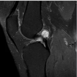 Fig. 3  Arthroscopic image of the right knee in flexion shows the cyst  (arrow) located behind the anterior cruciate ligament (ACL)