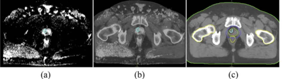 Figure 1. Representative image demonstrating intraprostatic lesion (a) in diffusion weighted MR scan and (b) coregistered MR and CT scans