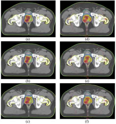 Figure 3. Representative axial CT slices showing 95% of prescribed dose distributions for (a) 6 MV, (b) 10 MV, (c) 15 MV energy intensity-modulated RT (IMRT) plans and (d) 6 MV, (e) 10 MV, (f) 15 MV energy volumetric-arc therapy (VMAT) plans.