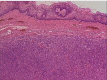 Figure 3: Two mitotic figures are seen in a high power field  (H&amp;E; x400). 
