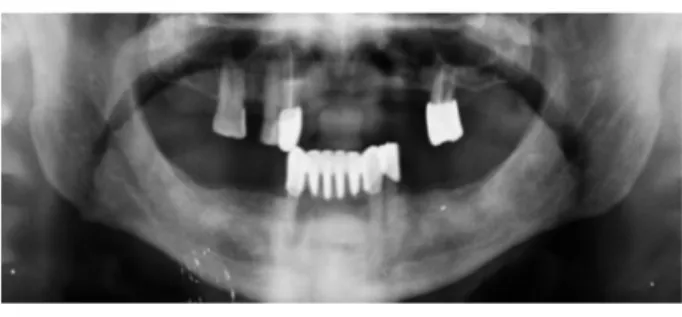 Figure 1. Note the Irregular Radiolucent Area Around Tooth # 44
