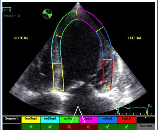 Figure 10.  Automatically defined cardiac cycle that starts at non-QRS electrical activity, which 