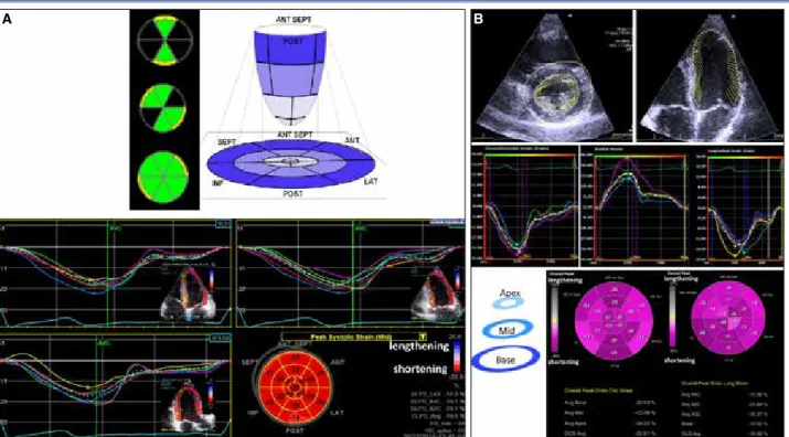 Figure 12.  (A) Display of global longitudinal strain. Left ventricular cut planes from apical 4-chamber, 2-chamber, and apical long 