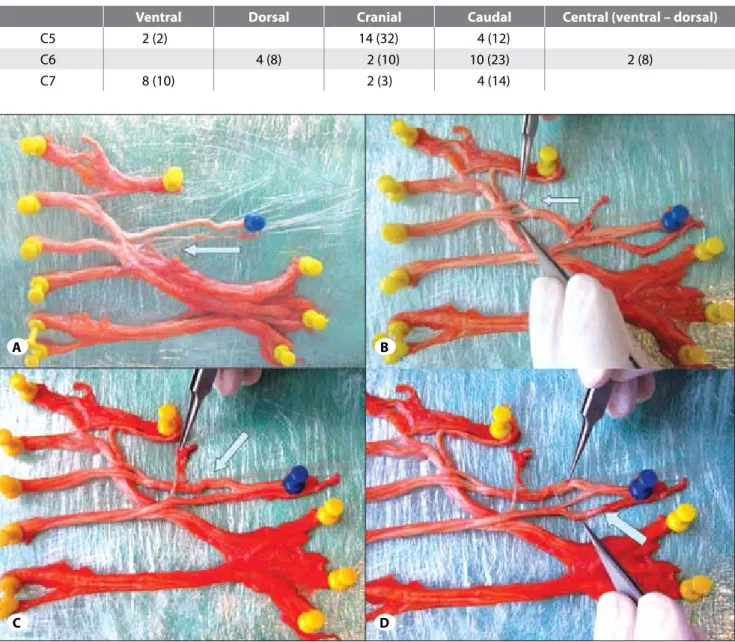 Figure 2: Brachial plexus extracted. A) Arrow shows fascicles from the trunks uniting to form divisions