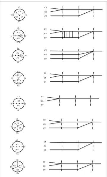 Figure 3: Variations in the axial distribution of spinal root  fascicles in musculocutaneous nerve and joining levels of spinal  root fascicles to form musculocutaneous nerve