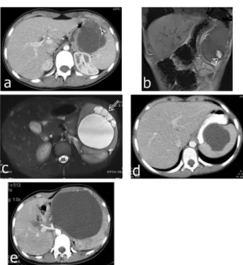 Fig. 2 Microphotograph reveals the spectrum of splenic cysts. a, b Cystic formation lined by flattened cells