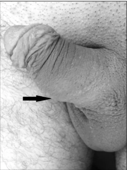 Fig. 1.Left lateral view of the penis showing enlargement on the 