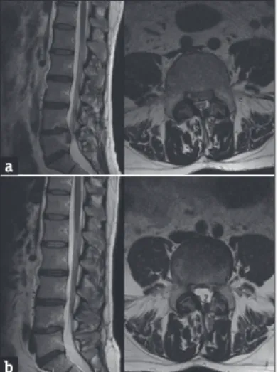 Figure 2: (a) Sagittal and axial T2‑weighted MRI of the lumbar spine  revealing an L4‑5 sequestrated disc herniation compressing the spinal  canal and bilateral L5 roots