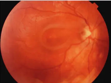 Figure 2A. Fundus photoghraph of the right eye showing resolution of the optic  disc pit maculopathy