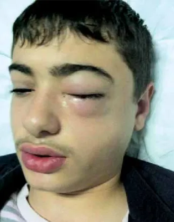 Figure 1. The gross view of the patient’s face. A marked left peri-