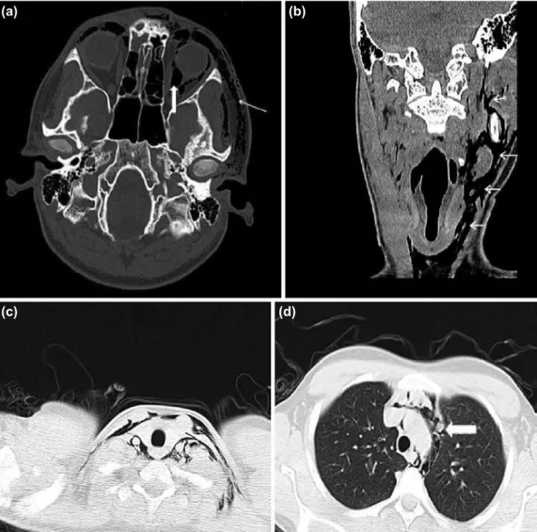 Figure 2. (a) Axial section of the facial CT shows a hypodense appearance consistent with air (white arrow) be-
