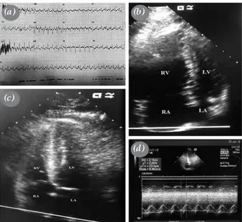 Figure 1. On admission, (a) 12-lead-electrocardiography showing 