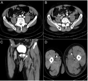 Fig. 2 A retrievable inferior vena cava ﬁlter was placed via right jugular vein approach before performing mechanical thrombectomy to  pre-vent potential embolic complications.