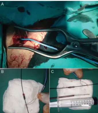 Fig. 4 Shaft of the thrombectomy catheter without distal part was led out from the vascular sheath.