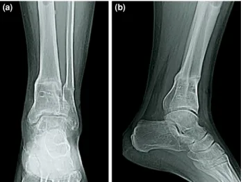 FIGURE 5.  (a,b)  Postoperative radiographies of Case 2 at 