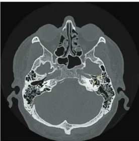 Figure 1. CT scan (axial plane) of patient (S5) shows left 