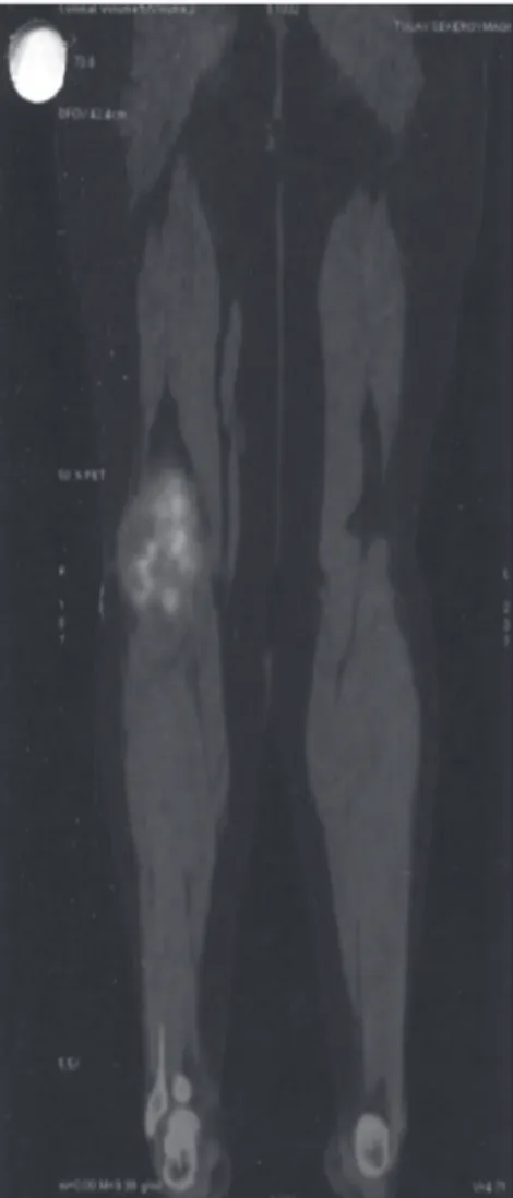 Figure 4. Case 1: Computed tomography evaluation following treatment with  pazopanib revealed a good partial response.