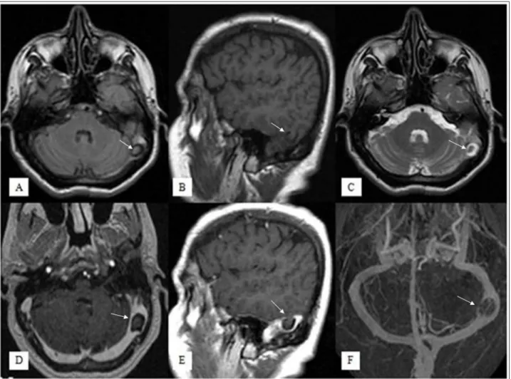 Figure 1: Fluid Attenuated Inversion Recovery axial (A), T1-weighted sagittal (B), T2-weighted axial (C), contrast-