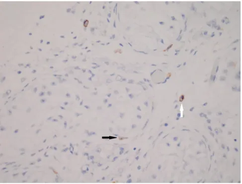 Şekil  4.4.  Matürasyon  arresti  grubundaki  olgularının  testis  dokusunda  Cajal  benzeri  hücreler  (CD117; X400)