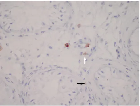 Şekil  4.6.  Testiküler  atrofi  ve  fibrozis  grubundaki  olgularının  testis  dokusunda  Cajal  benzeri  hücreler (CD117; X400)