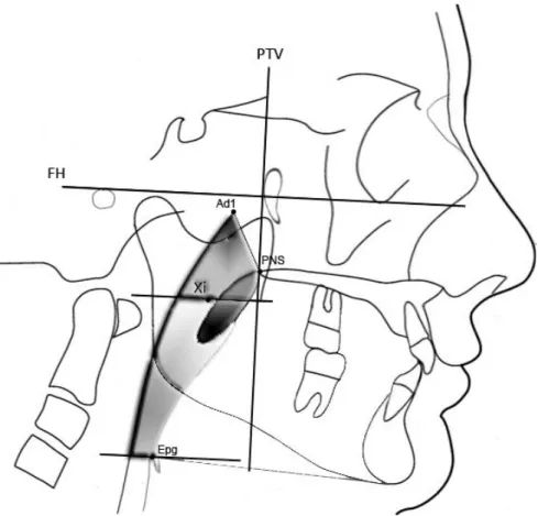 Figure 2. The intercanine (IC) and intermolar (IM) distances on the digital models.