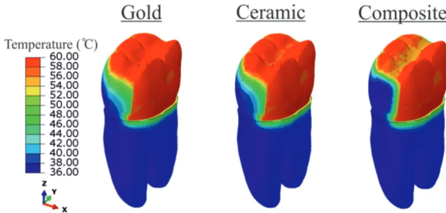 Fig. 8  Temperature distributions under 60ºC thermal condition at 2 s in the restored teeth.