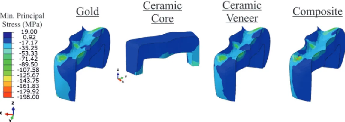 Fig. 11  Compressive stress patterns under 200-N mechanical loading at 60°C for 2 s in inlays.