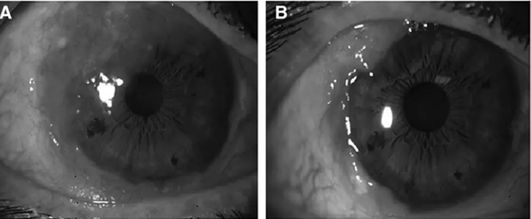 FIG. 1. Patient 1 before (A) and after (B) topical  bev-acizumab treatment. Reduction in the tumor size was observed both in the conjunctival and corneal portions of the tumor.