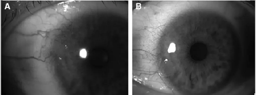 FIG. 2. Patient 2 before (A) and after (B) topical  bev-acizumab treatment. Surgical treatment was not necessary due to complete disappearance of the tumor, which was  con-firmed by impression cytology.