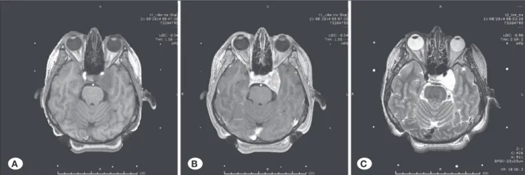 Figure 1: Prior to treatment,T1-weighted pre-contrast (A), post-contrast (B), and T2-weighted (C)  magnetic resonance images 