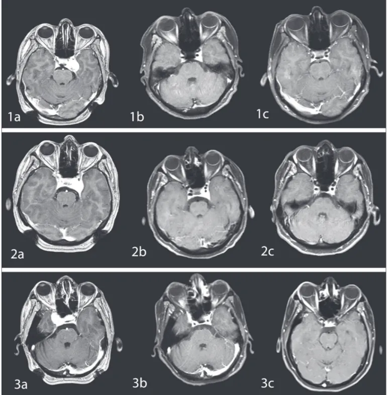 Figure 3:  T1-weighted  post-contrast  magnetic  resonance  (MR)  images  of  three  different  CSH  patients  treated  with  Gamma  Knife 